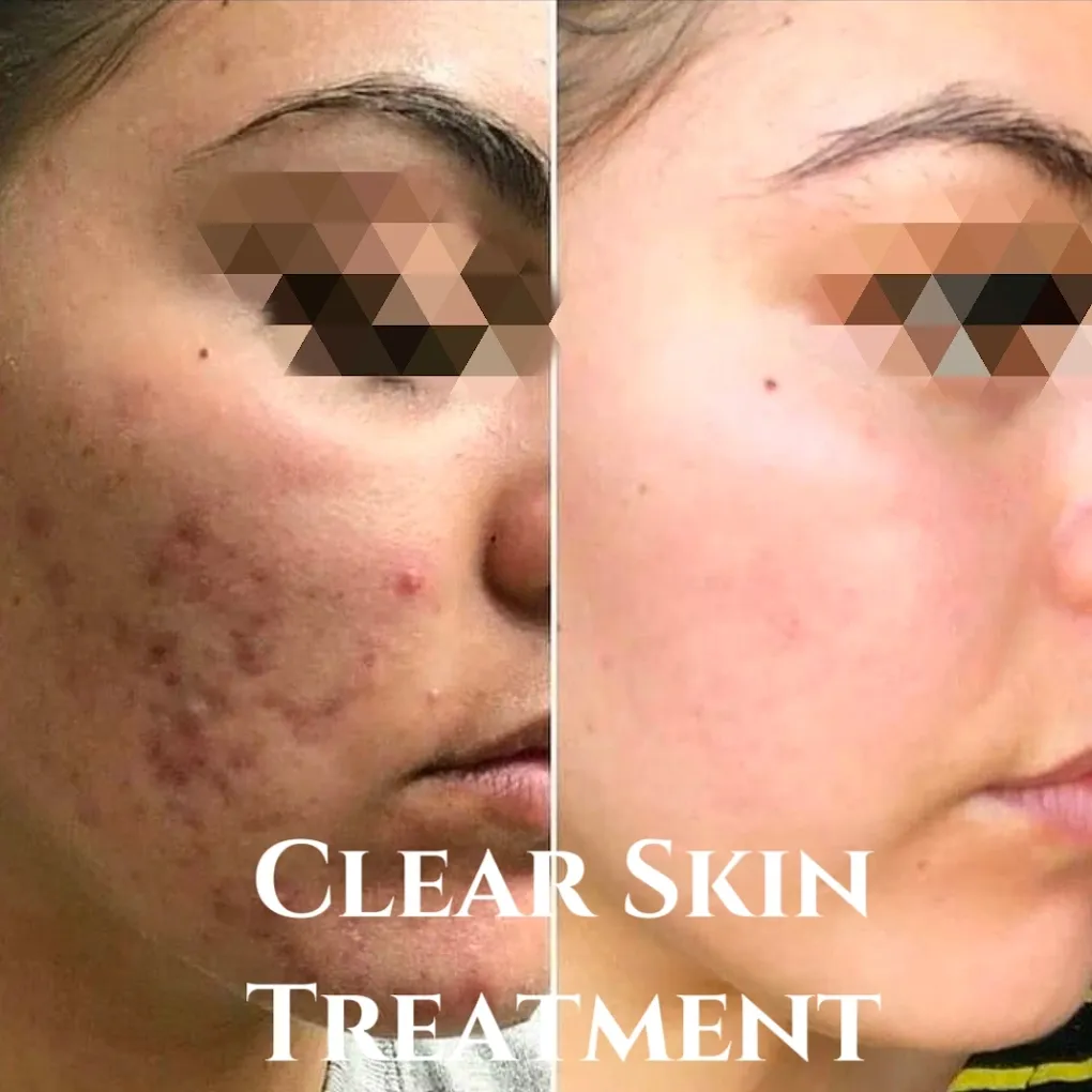 Clear Skin Behandlung - Zaira Beauty